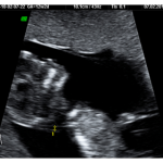 ultrasonografia